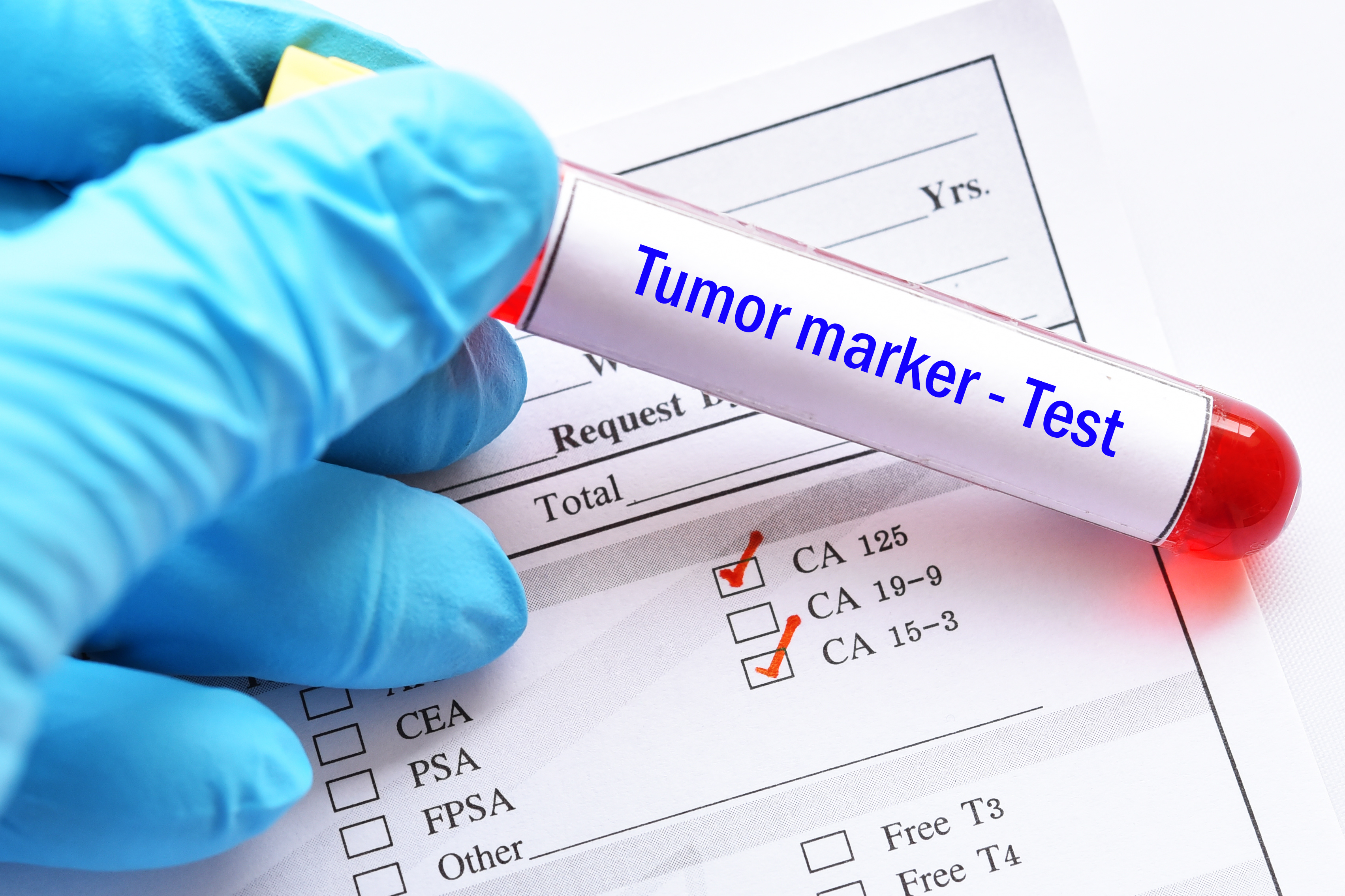 腫瘍マーカーとは Psaやca125などがんリスクの発見に役立つ血液検査 人間ドックなび