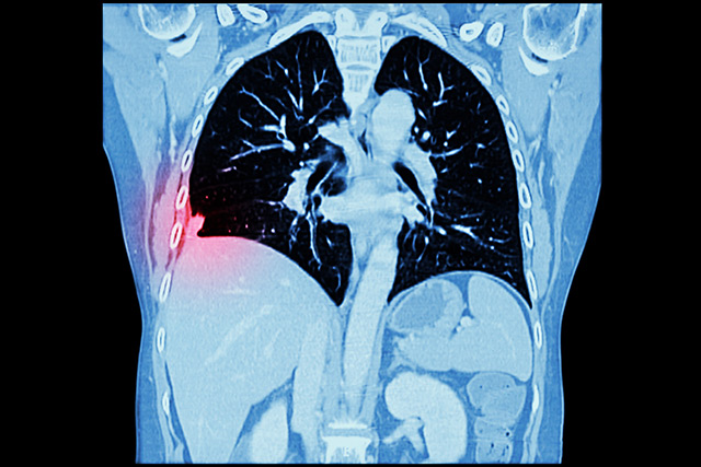 胸部CT検査イメージ