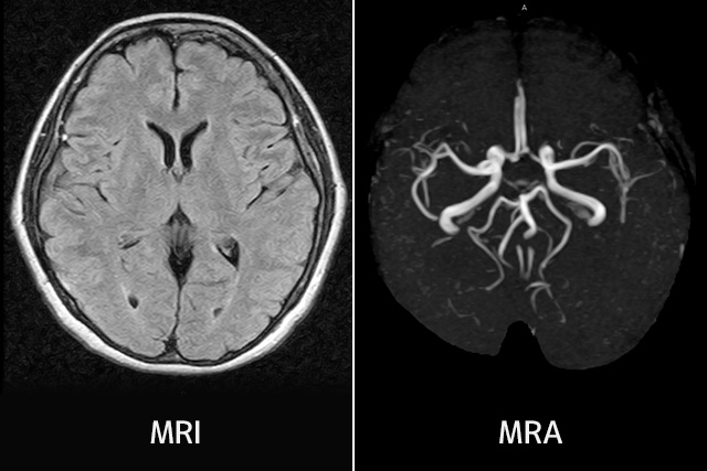 MRIは脳の軟部組織を、MRAは脳血管を画像として映し出すことができます。