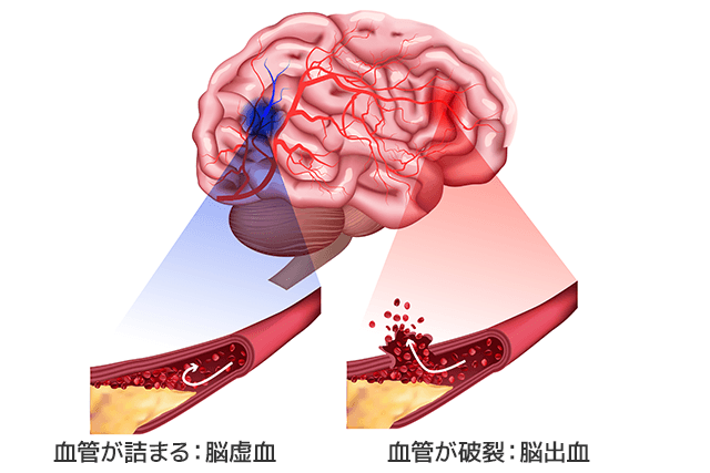 脳卒中の違い。脳の血管がつまった場合は「脳虚血（のうきょけつ）」、破れた場合は「脳出血（のうしゅっけつ）」となる。