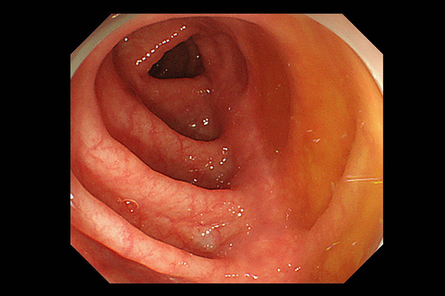 大腸内視鏡イメージ
