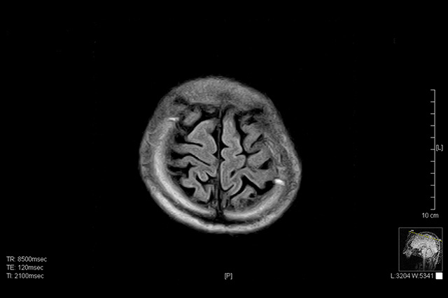 脳検査のイメージ